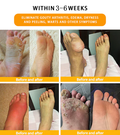 Raindew™ Bee Venom Lymphatic Drainage & Slimming Foot SoakBeads 70% OFF🎉🎉【Doctor recommendation - For all lymphatic problems and obesity】