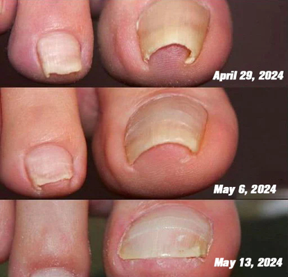 Raindew™ Bee Venom Nail Fungus Treatment Solution: The Complete Solution to Nail Folliculitis🌟👣