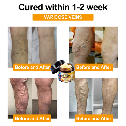 Aetheris™ Bee Venom Arthritis Therapy Cream(AAOS recommends)