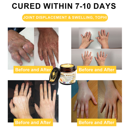 Raindew™ ArthroEase Bee Venom Joint and Bone Arthritis Therapy Cream(Specially for older adults & AAOS recommends)