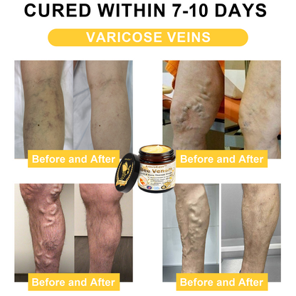 Raindew™ ArthroEase Bee Venom Joint and Bone Arthritis Therapy Cream(Specially for older adults & AAOS recommends)