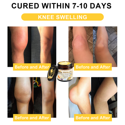 Raindew™ ArthroEase Bee Venom Joint and Bone Arthritis Therapy Cream(Specially for older adults & AAOS recommends)